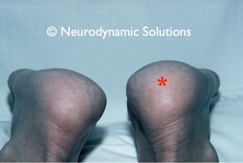 needle pain in heel